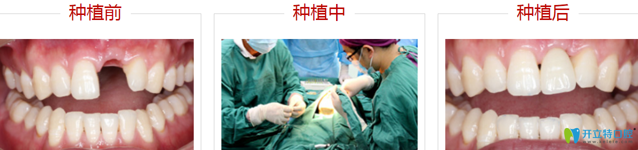 深圳哪里種牙比較好？來(lái)看格倫菲爾種植牙案例