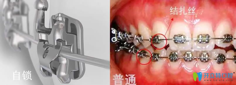 自鎖托槽矯正一萬貴嗎？自鎖托槽比金屬托槽好在哪里？