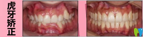成人虎牙矯正案例及前后對(duì)比照