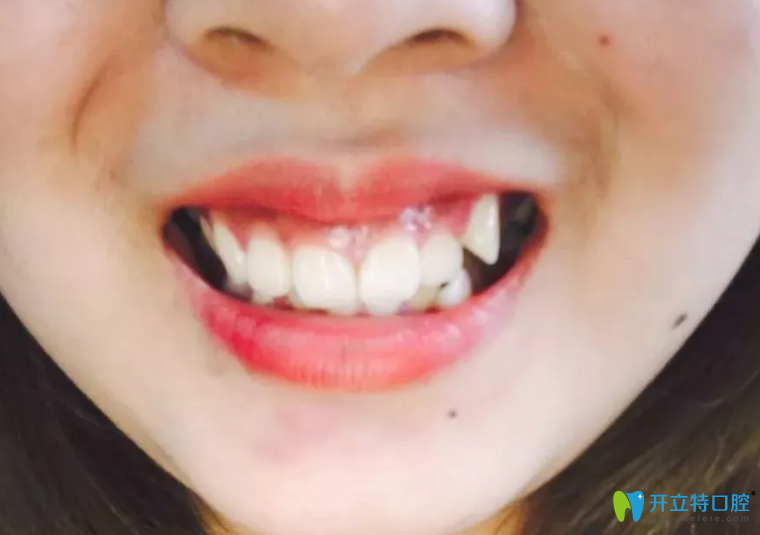 戴隱適美矯正牙齒前