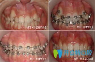 唇側(cè)矯正案例效果圖