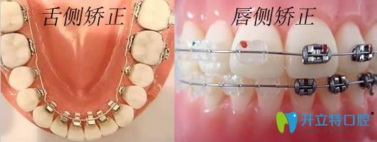 舌側(cè)矯正和唇側(cè)矯正對(duì)比圖片