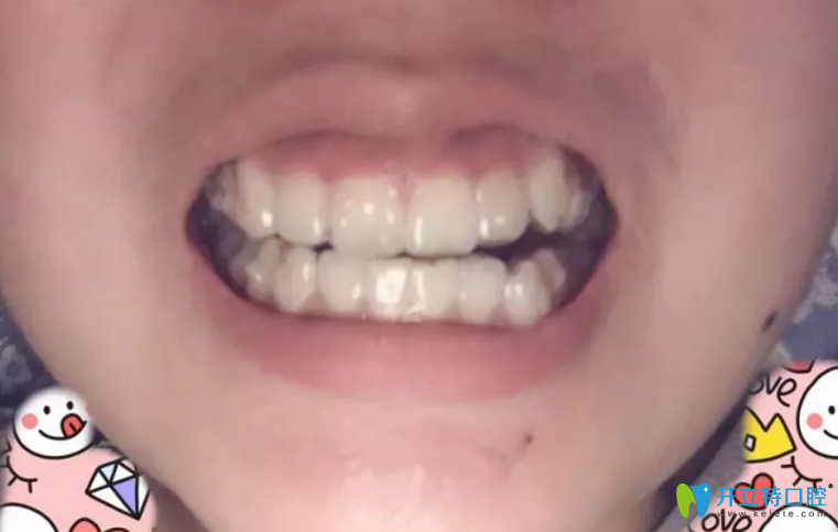 找<!--<i data=20240703-sp></i>-->口腔劉珊做正畸戴第十三副隱形牙套圖