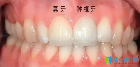 種植牙和真牙一樣嗎？不妨來看咀嚼功能及使用壽命的區(qū)別