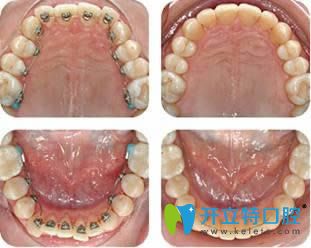 舌側(cè)矯正案例效果對(duì)比圖