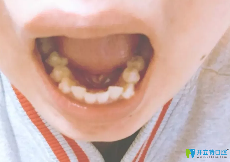 在<!--<i data=20240703-sp></i>-->口腔做隱適美矯正下排牙第九副隱形牙套