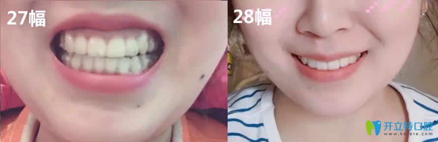 新橋口腔矯正牙齒戴第27-28副牙套牙齒變化圖