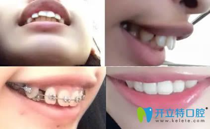 <!--<i data=20240703-sp></i>-->恒愿齒科吳鵬齙牙矯正案例圖