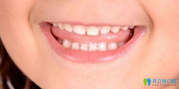 兒童換牙前矯正牙齒還是換牙后?附兒童牙齒矯正方法及價格