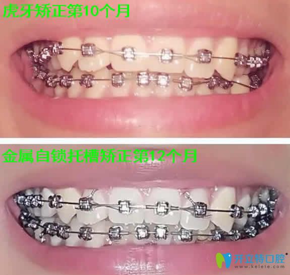 我在天津瑞金口腔做金屬自鎖托槽矯正過程圖