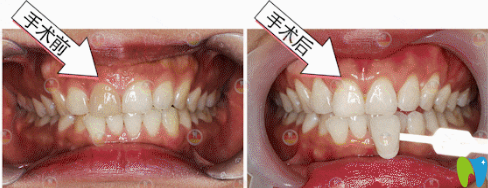 廣州德倫口腔皓齒美白+貼面修復(fù)案例對比圖