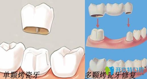 單顆烤瓷牙和多顆烤瓷牙修復(fù)圖