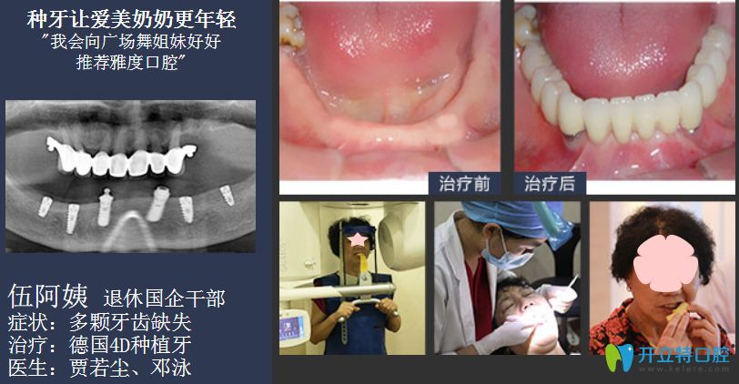 廣州種植牙價格表,看廣州穗華/柏德/德倫等排名前10醫(yī)院收費(fèi)