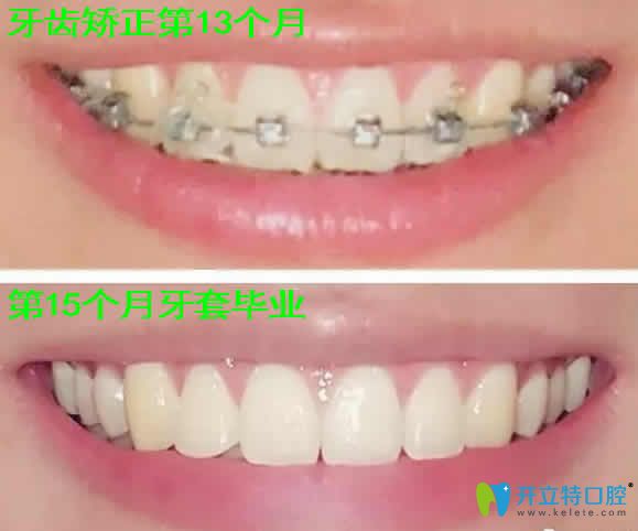 我在天津瑞金口腔做虎牙矯正15個月照片