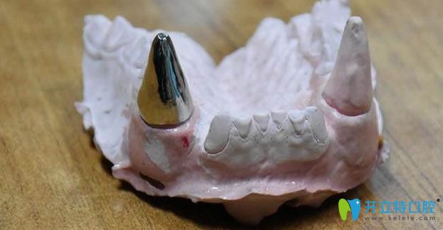 為什么要給“團團”選擇“鈦金屬”材牙套