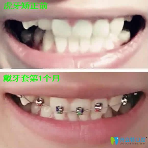 天津瑞金口腔虎牙矯正真人案例 見證金屬自鎖托槽價(jià)格不貴