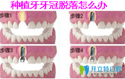 種植牙牙冠脫落怎么辦