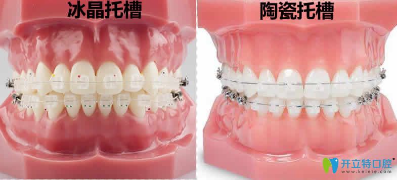 想知道冰晶托槽和陶瓷托槽哪個(gè)好?快來(lái)看兩個(gè)牙套的區(qū)別吧