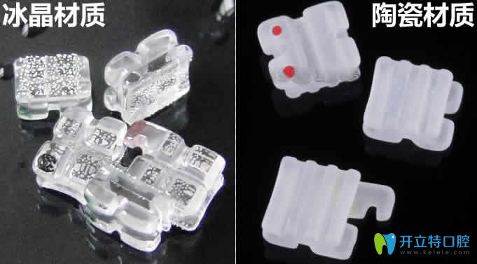 冰晶牙套與陶瓷牙套材質(zhì)區(qū)別圖