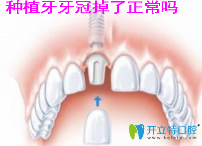 種植牙牙冠掉了正常嗎