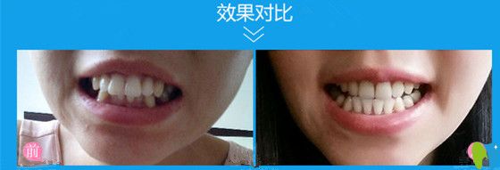 姜輝主任牙齒矯正前后對比照