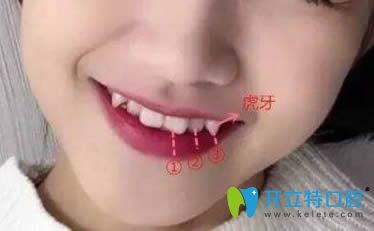 談虎牙矯正好還是拔除好?矯正虎牙(尖牙)價(jià)格是多少錢？