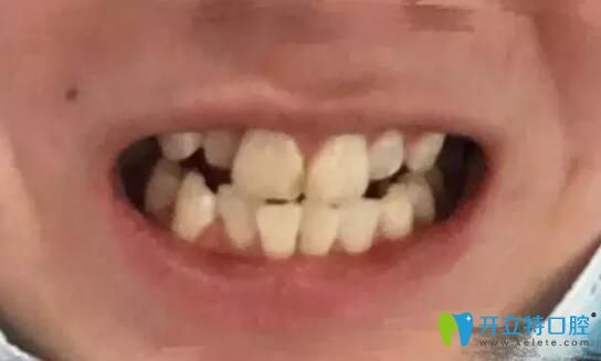 去北京南區(qū)口腔做牙齒二次矯正前樣子