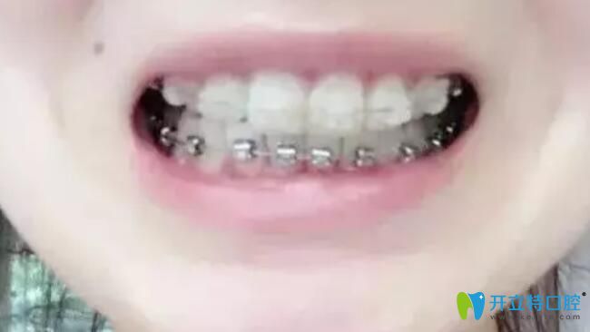 選擇在北京南區(qū)口腔做牙齒正畸戴牙套圖
