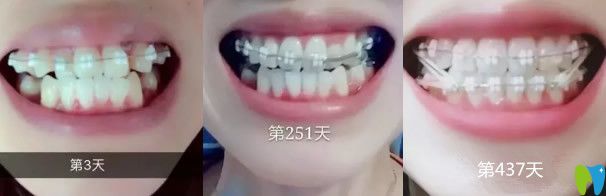 牙齒矯正前后對比圖