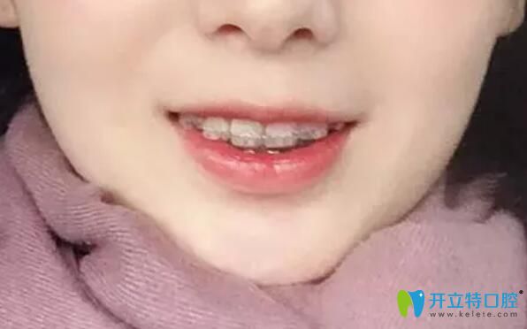 我在北京南區(qū)口腔做了正畸