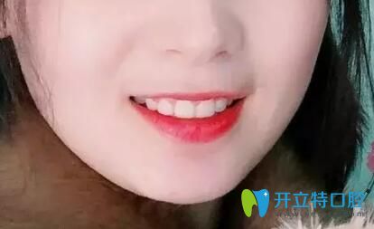 北京南區(qū)口腔牙齒矯正摘掉牙套后照片