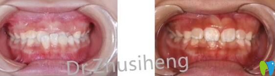 三葉口腔孩子“地包天”早期干預(yù)矯正案例