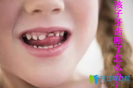 小孩的牙齒斷了怎么辦？點(diǎn)擊了解兒童牙齒修復(fù)的方法