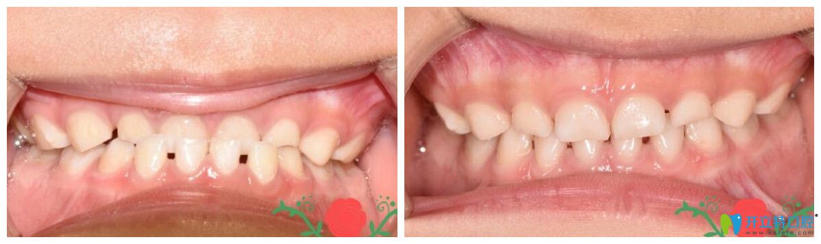 孩子地包天矯正效果怎么樣？來看一下真實案例吧