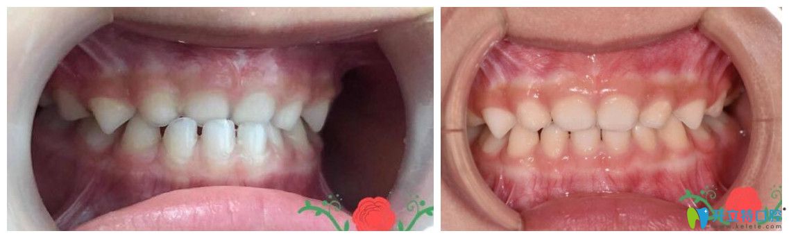 3歲的小女孩地包天矯正案例對比圖