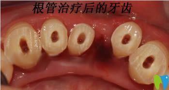 做過(guò)根管治療后的牙齒圖 做過(guò)根管治療后的牙齒圖