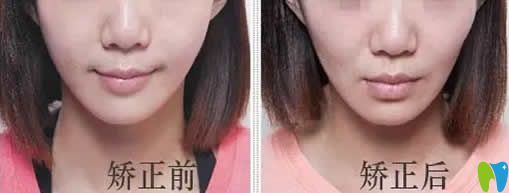 牙套臉會恢復(fù)嗎
