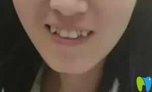 牙齒矯正改變臉型嗎？附我在西安優(yōu)德口腔正畸15個(gè)月效果圖