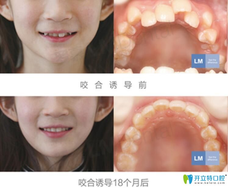 <!--<i data=20240703-sp></i>-->兒童口腔好不好？來(lái)看兒童羅慕誘導(dǎo)矯正案例