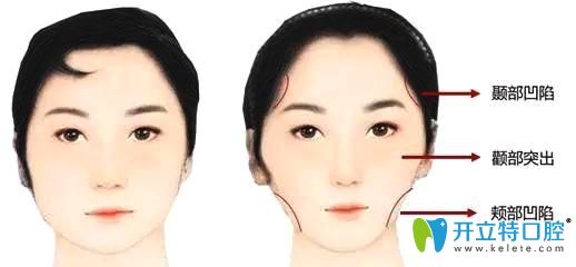 牙齒矯正中牙套臉是怎么形成的？什么臉型容易出現(xiàn)牙套臉