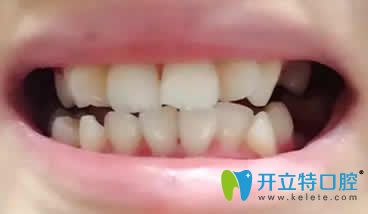 我在竹子口腔做隱形矯正第3個月照片