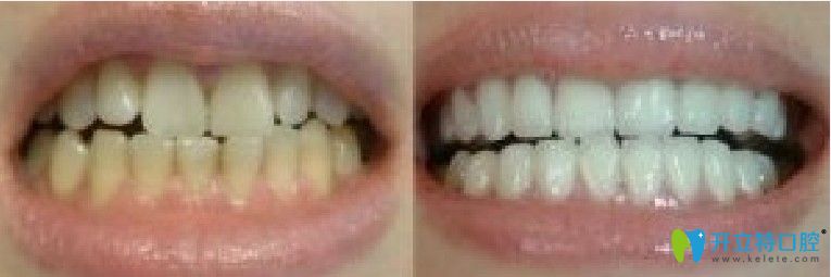 竹子口腔牙齒冷光美白前后對比圖