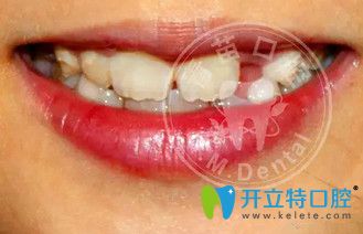 <!--<i data=20240703-sp></i>-->兒童口腔羅慕誘導(dǎo)矯正牙齒反頜案例效果圖