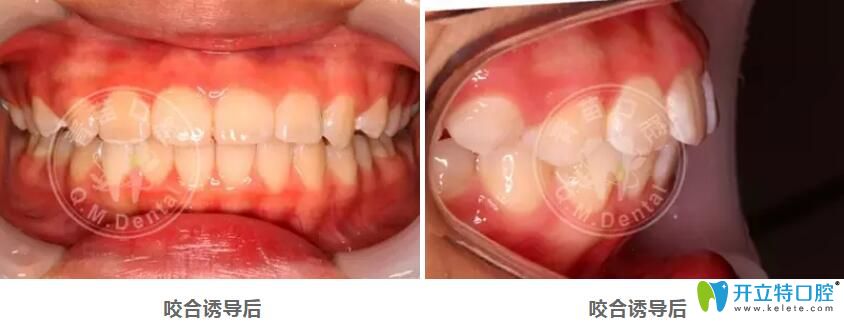 <!--<i data=20240703-sp></i>-->兒童口腔深覆頜矯正后照片