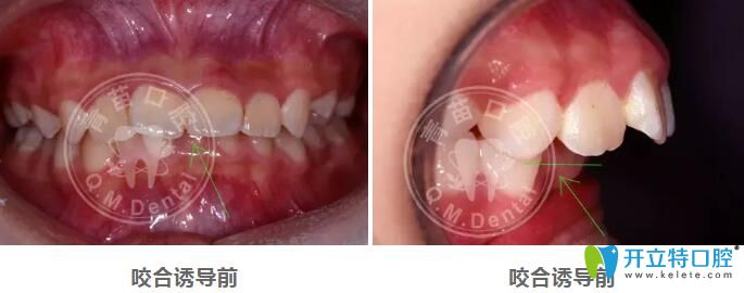 兒童咬合誘導(dǎo)哪家好？深圳青苗口腔羅慕咬合矯正案例驗(yàn)證