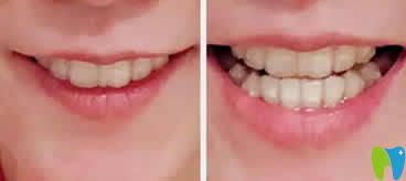 我在昆明竹子口腔戴牙套第9個月照片