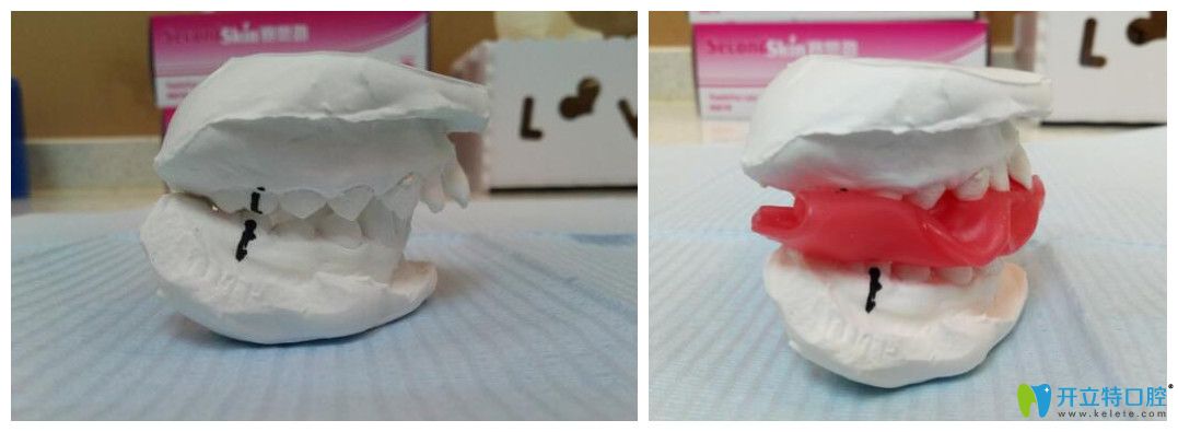 去<!--<i data=20240703-sp></i>-->兒童口腔做矯正前取模型