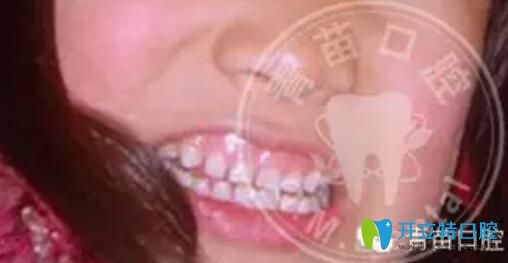 兒童露齦笑咬合誘導(dǎo)矯正案例