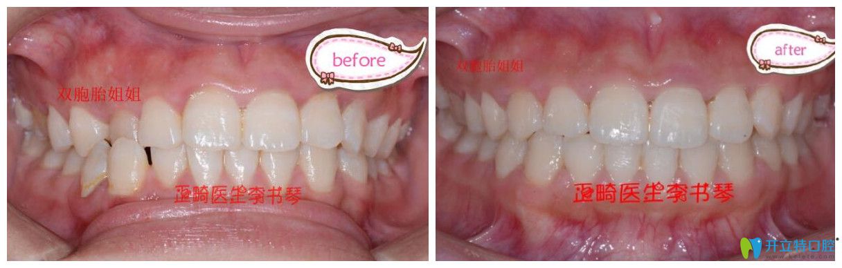 茁悅口腔牙齒錯(cuò)頜畸形矯正案例效果對(duì)比