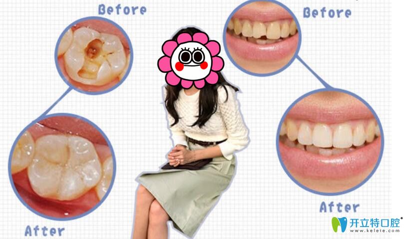 茁悅口腔3M樹脂補(bǔ)牙真人案例前后效果對比